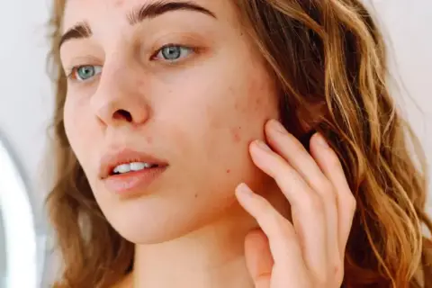 Une jeune femme aux yeux bleus touche son visage, marqué par des rougeurs et des imperfections. Elle cherche à hydrater le visage pour retrouver une peau nette.