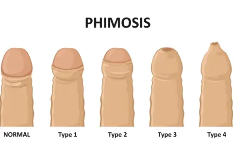 Ilustracja pokazuje stopnie stulejki (phimosis). Porównuje normalny stan z czterema typami, gdzie napletek co to jest, jest widocznie zwężony.