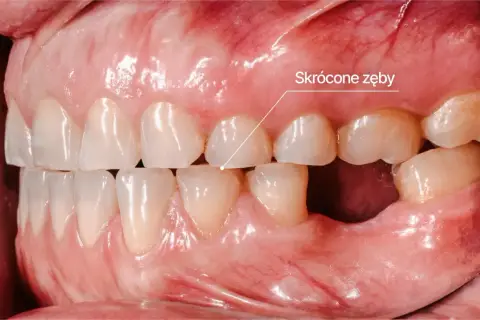 Zęby skrócone przez bruksizm. Widoczne starte siekacze i brak zębów trzonowych.