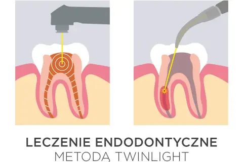 Ilustracja pokazuje laserowe leczenie zębów. Dwa etapy endodoncji z użyciem lasera, który precyzyjnie dociera do wnętrza zęba.