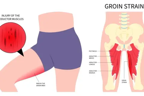 Illustration zeigt eine Zerrung der Adduktorenmuskeln im Leistenbereich. Wo ist die Leiste? Hier, rot markiert, mit Schmerz im Leistenbereich.