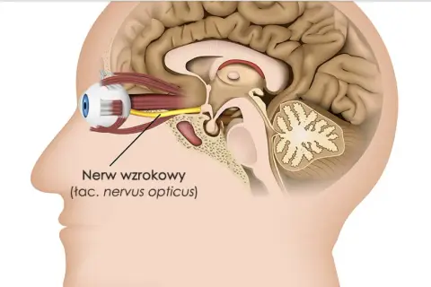Schematyczny przekrój głowy ukazujący oko i mózg. Strzałka wskazuje nerw wzrokowy, którego uszkodzenie może prowadzić do utraty wzroku.