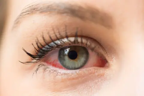 Rotes, gereiztes Auge mit sichtbaren Äderchen. Vielleicht ein Fall für Bindehautentzündung Hausmittel?
