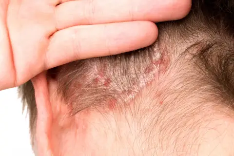 Una mano cubre parte de la cabeza, revelando un cuero cabelludo irritado con enrojecimiento y escamas blancas.