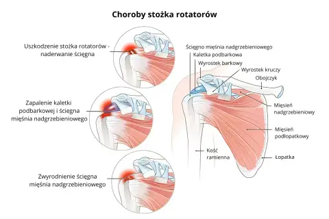 Ilustracja pokazuje budowę barku i schorzenia stożka rotatorów, w tym uszkodzenie, zapalenie i zwyrodnienie ścięgna mięśnia nadgrzebieniowego.