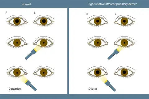 Ilustracja porównuje reakcję źrenic w oku normalnym i z prawostronnym deficytem aferentnym. Widoczna anizokoria, czyli nierówność źrenic, jest kluczowa w diagnostyce.