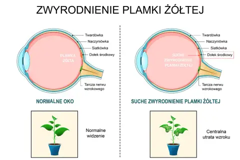 Porównanie zdrowego oka z plamką żółtą i oka z suchym zwyrodnieniem plamki żółtej, pokazujące utratę centralnego widzenia.