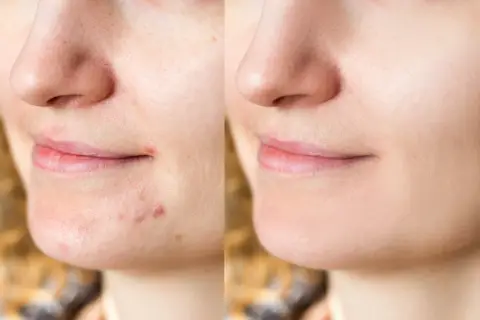 Avant/après : une peau avec des boutons et des pores dilatés devient lisse et nette. Découvrez comment faire disparaitre un bouton pour un teint parfait.