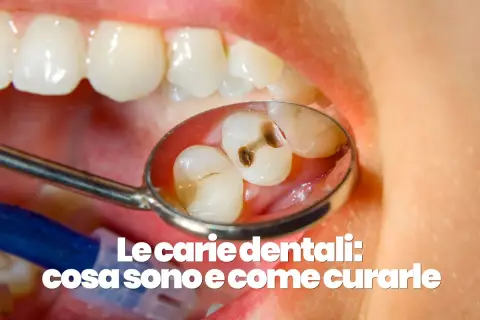 Denti con evidenti carie visibili nello specchietto del dentista.