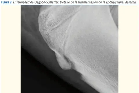 Radiografía de rodilla que muestra fragmentación de la apófisis tibial derecha, indicativo de Osgood-Schlatter.