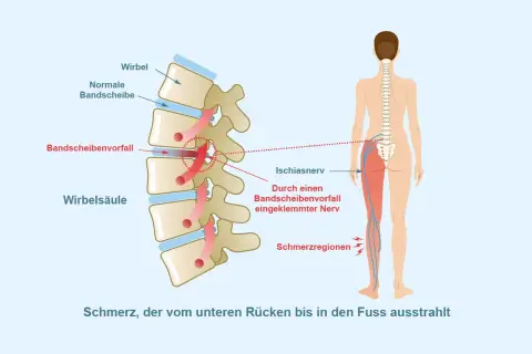 Bandscheibenvorfall klemmt Ischiasnerv ein, verursacht Schmerz vom Rücken bis zum Fuß. Was hilft sofort bei Ischias?