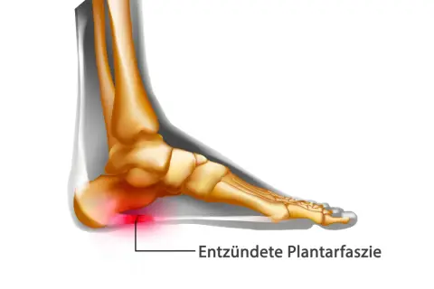 Entzündete Plantarfaszie im Fuß, die Schmerzen verursacht. Die Plantarfasziitis wird immer schlimmer.
