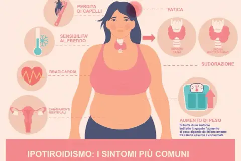 Ipotiridismo: sintomi come perdita capelli, stanchezza, aumento peso e ansia. La tiroide ipotiroidea causa questi disturbi.