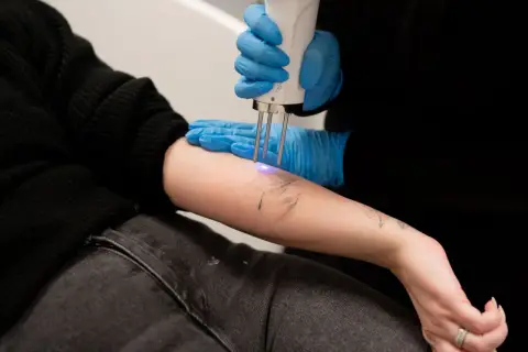 En person får en tatuering borttagen med laser. Undrar du över ta bort tatuering pris?