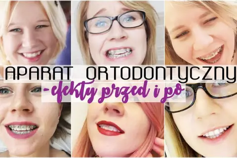 Aparat ortodontyczny a usta: Iluzja czy realna zmiana?