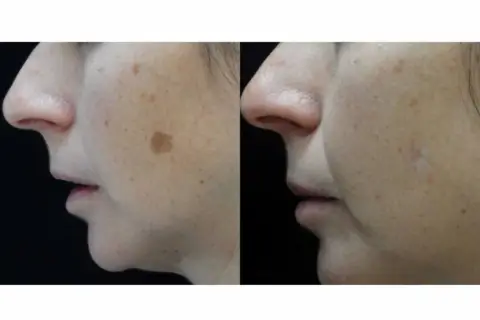 Comparación de piel con manchas solares antes y después de un tratamiento.