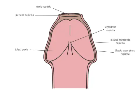 Schemat penisa z widocznym zwężeniem napletka, czyli stulejką u dorosłego. Pokazuje żołądź, napletek i jego budowę.