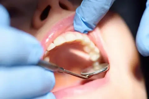 Dentysta bada zęby, szukając oznak próchnicy wtórnej.