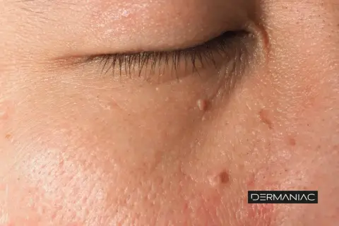 Primer plano de la piel con varias verrugas en la cara, algunas cerca del ojo.