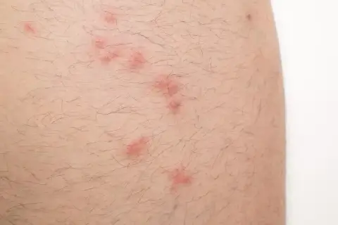 Czerwone, swędzące ślady na skórze, które mogą świadczyć o tym, czy pchły z kota przejdą na człowieka.