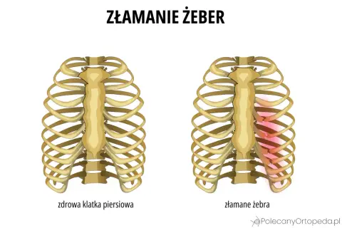 Porównanie zdrowej klatki piersiowej z tą, gdzie widoczne są stłuczone żebra bez siniaka, zaznaczone czerwonym rumieńcem.