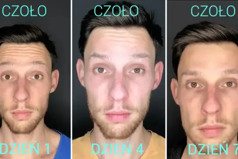 Trzy zdjęcia mężczyzny pokazujące ewolucję czoła po zabiegu. Dzień 1: widoczne zmarszczki. Dzień 4 i 7: wygładzone czoło, dziwne uczucie po botoksie.