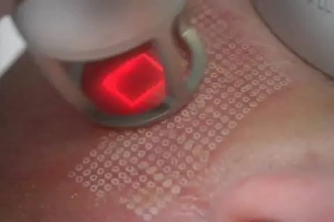 Jak wygląda zabieg laser frakcyjny? Efekty i co warto wiedzieć