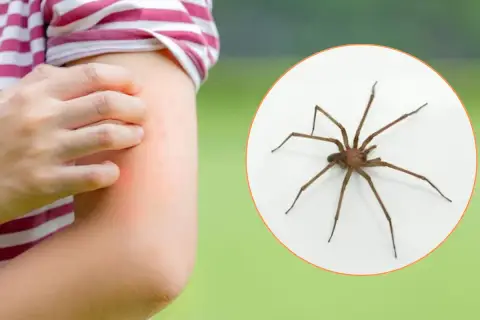 Brazo con erupción roja y picazón, junto a una araña marrón. Aprende cómo curar picadura de araña.