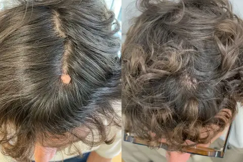 Comparación de verrugas en la cabeza antes y después del tratamiento.