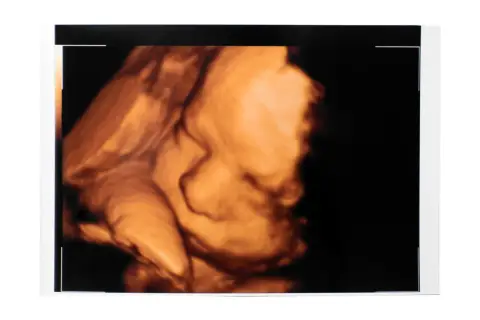 Ecografia 3D di un feto. Il profilo del bambino è ben visibile, con la bocca e il naso definiti. Dopo la morfologica si può stare tranquilli.