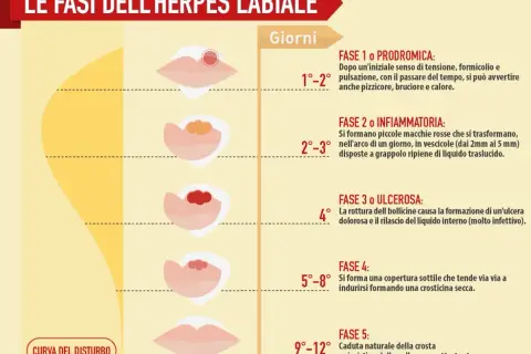 Le fasi dell'herpes labiale: dalla fase prodromica (1-2 giorni) con pizzicore, alla formazione di vescicole (2-3 giorni), ulcere (4° giorno), crosticine (5-8 giorni) fino alla guarigione (9-12 giorni). Le cause del herpes labiale frequente sono legate ...