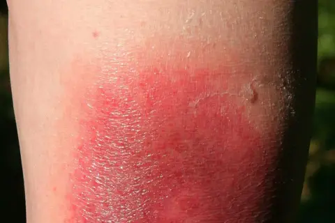 Symptome Borreliose beim Menschen: Warnzeichen, die Sie kennen sollten