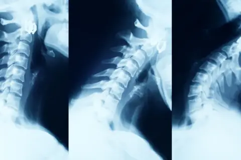 Rentgen kręgosłupa szyjnego ukazujący zmiany zwyrodnieniowe. Widoczne są osteofity i zwężenia przestrzeni międzykręgowych, świadczące o zaawansowanym zwyrodnieniu kręgosłupa.