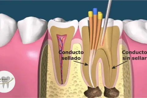 Ilustración de un diente mostrando un conducto radicular sellado y otro sin sellar, con instrumentos dentales. Esto explica qué es una reendodoncia.