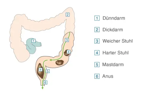 Darstellung des Verdauungstrakts. Harter Stuhl (4) im Dickdarm (2) kann eine Verstopfung lösen, bevor er den Mastdarm (5) erreicht.