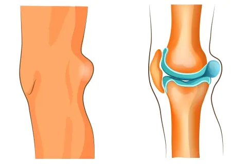 Knie mit Bakerzyste, die eine Schwellung hinter dem Kniegelenk zeigt. Die rechte Seite illustriert das Kniegelenk und die mögliche Bakerzyste, die eine Behandlung erfordert.