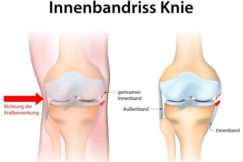 Illustration zeigt einen **Innenbandriss Knie**. Links die Kraftrichtung, rechts das gerissene Innenband im Vergleich zum gesunden.