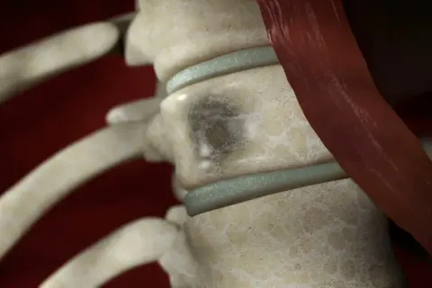 Detailaufnahme der Wirbelsäule mit einem dunklen Fleck auf einem Wirbelkörper, der auf multiples Myelom hindeutet. Woran stirbt man bei dieser Krankheit, ist eine wichtige Frage.
