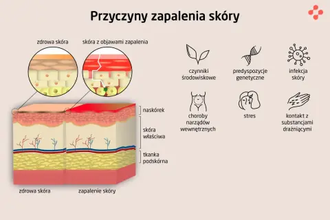 Ilustracja porównuje zdrową skórę z zapaleniem skóry, pokazując jego przyczyny: czynniki środowiskowe, genetykę, infekcje, choroby wewnętrzne, stres i kontakt z drażniącymi substancjami.