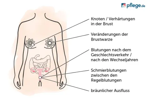 Illustration zeigt Symptome, die auf einen Unterschied zwischen Tumor und Karzinom hinweisen können: Knoten in der Brust, Brustwarzenveränderungen, Blutungen und Ausfluss.