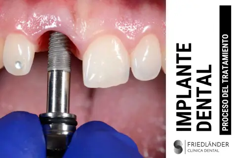 Proceso de colocación de un implante dental. Un tornillo metálico se inserta en la encía, cerca de dientes naturales.