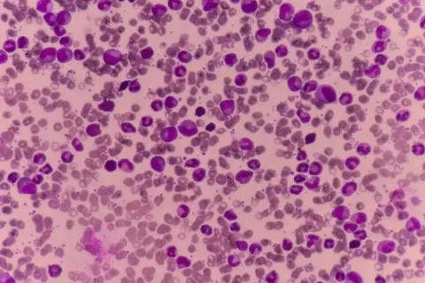 Mikroskopowy obraz rozmazu krwi z widocznymi komórkami o fioletowych jądrach i cytoplazmie.