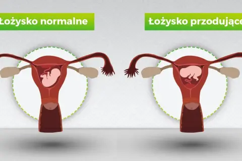 Porównanie: łożysko normalne vs łożysko przodujące. Grafika pokazuje macicę z płodem, ilustrując różnice w położeniu łożyska.