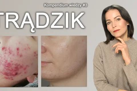 Czysta cera bez trądziku? Odkryj sekrety skutecznej profilaktyki