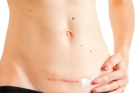 Frau trägt eine Creme auf eine Narbe am Bauch auf. Natürliche Hausmittel für die Narbenpflege können hier helfen.