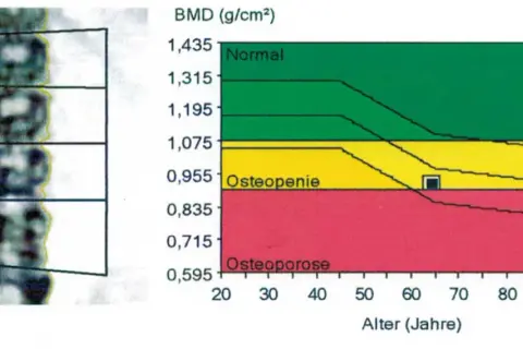 Osteoporose werte tabelle: Röntgenaufnahme der Lendenwirbel und eine Grafik, die den T-Wert im Verhältnis zum Alter zeigt. Grün: Normal, Gelb: Osteopenie, Rot: Osteoporose.