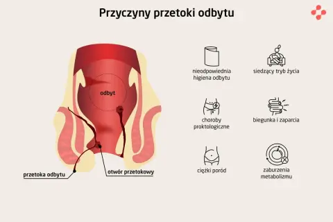 Ilustracja przedstawia anatomię odbytu z zaznaczoną przetoką odbytu. Obok wymieniono przyczyny: złą higienę, siedzący tryb życia, choroby proktologiczne, biegunkę, zaparcia, ciężki poród i zaburzenia metabolizmu.