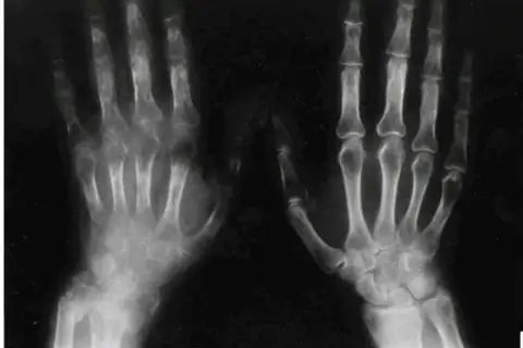 RTG dłoni ukazujący zmiany kostne charakterystyczne dla zespołu sudeckiego. Widoczne są objawy osteoporozy, obrzęki i zwężenia przestrzeni stawowych.