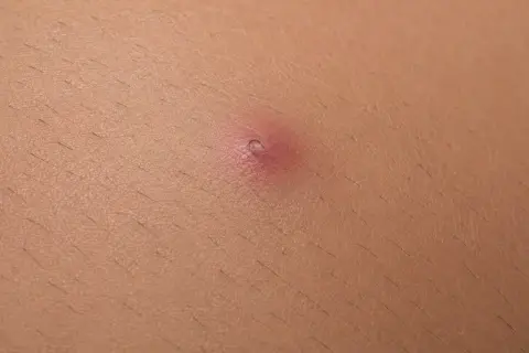 Primo piano di un pelo incarnito, un piccolo brufolo rosso sulla pelle. Ecco come togliere un pelo incarnito.