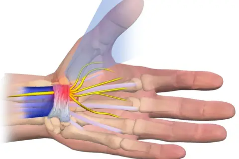Illustrazione anatomica dei nervi del polso, evidenziando la compressione e l'infiammazione dei nervi che si diramano verso le dita.